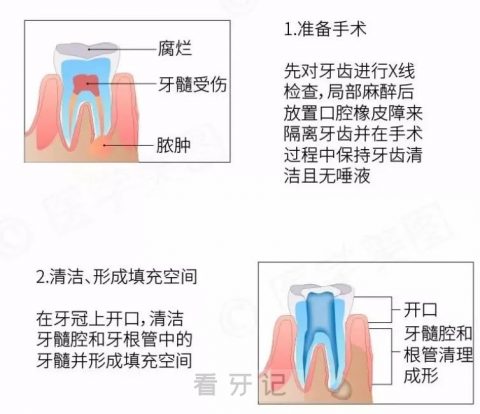 根管治疗看牙记含治疗价格明细（第五次去医院）