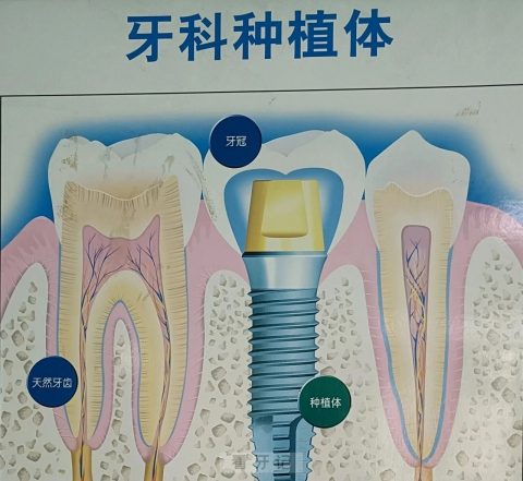 种植牙什么品牌比较好附前十大进口种植体品牌优势整理