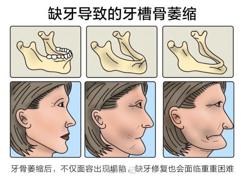 中老年人缺牙危害到底有多大