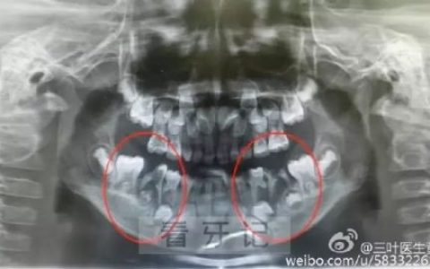太可怕了乳牙不治后果竟然会这么严重附图片