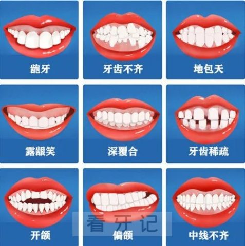 骨性凸嘴和牙性凸嘴哪个更严重有哪些区别