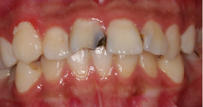 门牙蛀牙龋齿图片