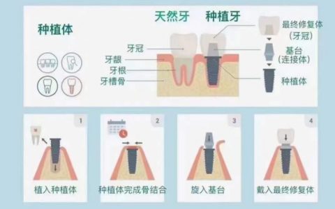 关于种植牙的结构和种牙过程看这张图片就够了
