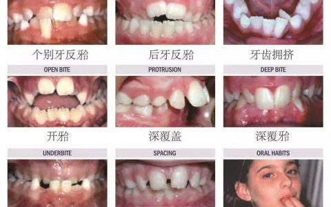 儿童牙齿畸形图片大全