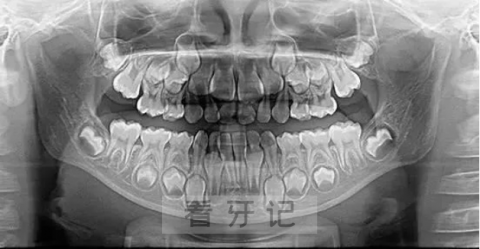 小朋友看牙为什么医生要求拍片