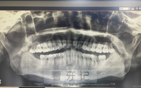 全景片是什么医院为什么要求必须拍全景片
