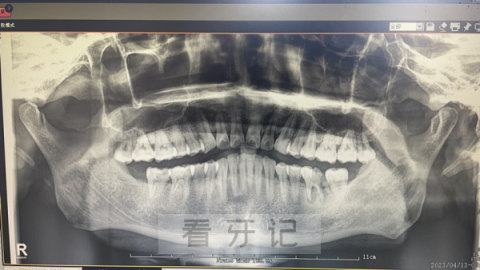 全景片是什么医院为什么要求必须拍全景片