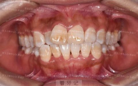 氟斑牙四大特点附氟斑牙真实照片图片
