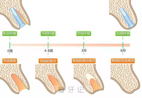 千万别做种植牙即拔即种？可能引发种牙失败