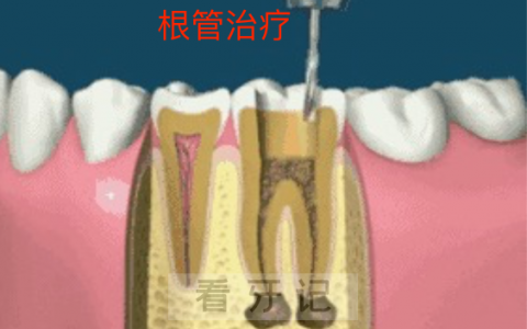 牙疼去看牙为啥让我做根管治疗