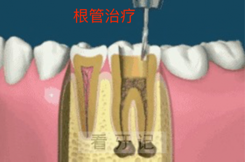 牙疼去看牙为啥让我做根管治疗