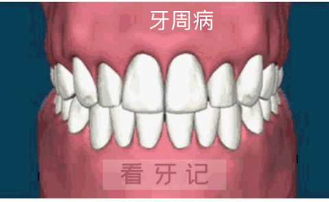 医生不给我种牙为什么要让我先治疗牙周病