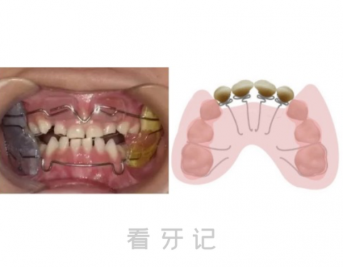 地包天牙齿矫正方式不同年龄段对应治疗方式