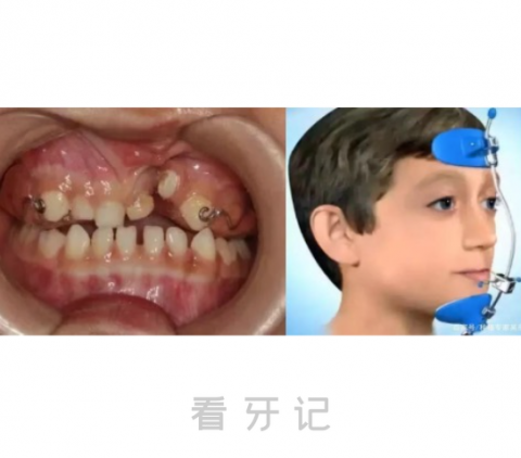 地包天牙齿矫正方式不同年龄段对应治疗方式