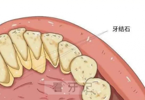 太顽固了牙结石形成的原因到底是什么