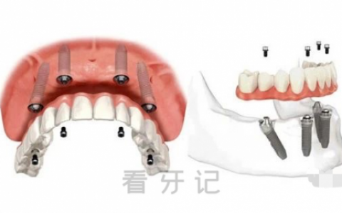 如果老人整排或者全口牙都掉了怎么办附解决方案
