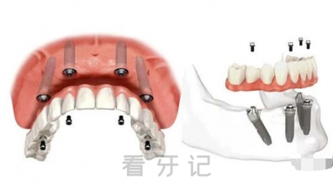 如果老人整排或者全口牙都掉了怎么办附解决方案