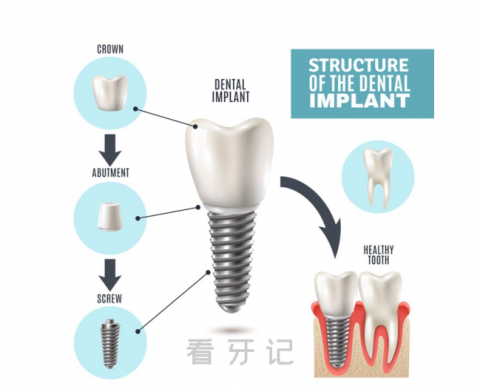 种植牙由哪些部分组成材料是否安全附英文版结构图