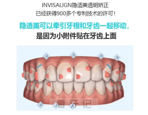 隐适美隐形矫正牙套佩戴流程