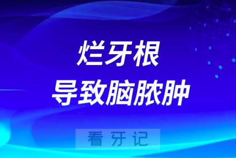 太可怕了“烂牙根”入脑导致脑脓肿