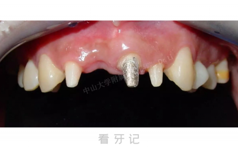 触目惊心天然牙固定桥镶牙对牙齿损害高清图片