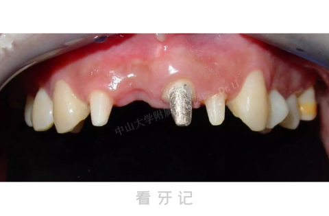 触目惊心天然牙固定桥镶牙对牙齿损害高清图片