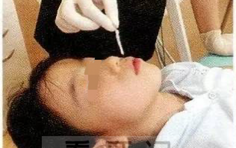 如何判断孩子有没有用口呼吸附最简单测试方法