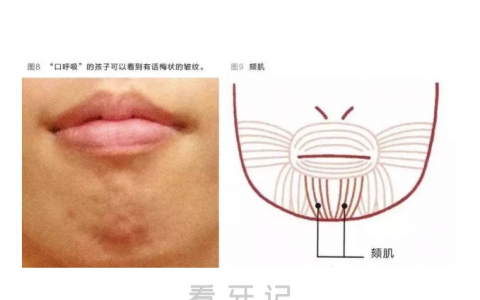 孩子下巴处有话梅纹路是不是口呼吸