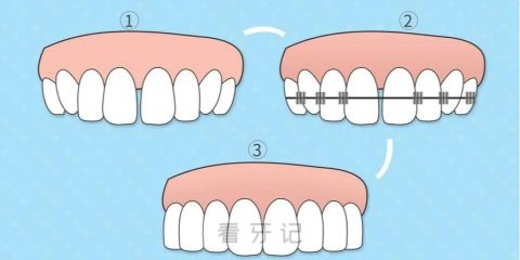 矫正牙齿完整过程图片视频