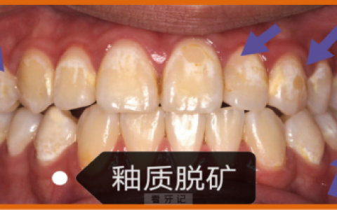 牙齿脱矿早期中期晚期照片附对比示意图