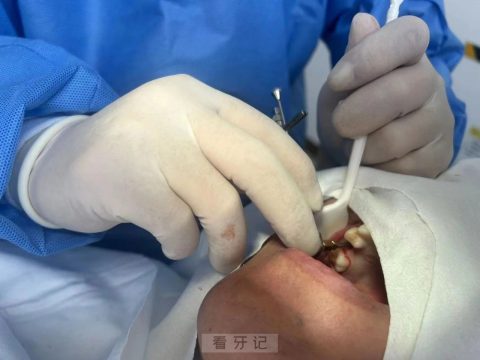 张家港市第五人民医院口腔科开展微创“种植牙”手术