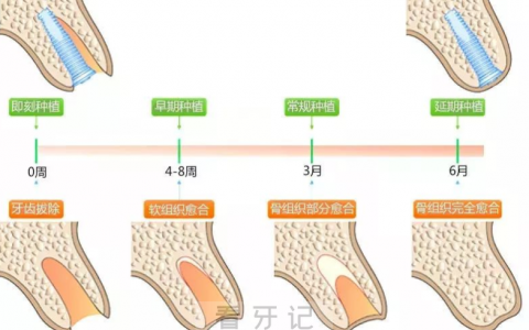 良心种植牙医生说不建议即拔即种是真的假的