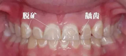 牙齿脱矿早期中期晚期照片附对比示意图