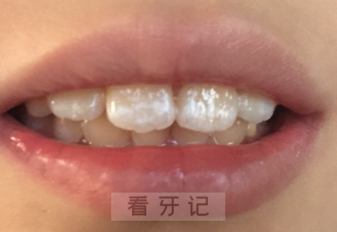 牙齿脱矿早期中期晚期照片附对比示意图