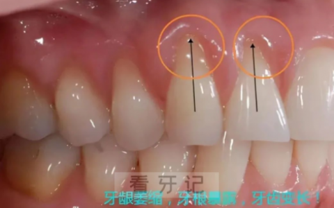 太可怕了如何阻止牙龈萎缩