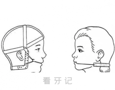 太可怕了是不是矫正医生让你打骨钉