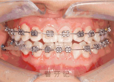 牙齿正畸治疗出现的心理问题研究整理