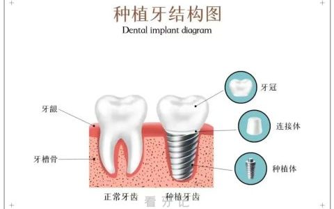 种植牙的时间要怎么选才适合附三大类型