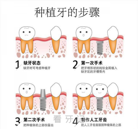 种植牙手术三大阶段