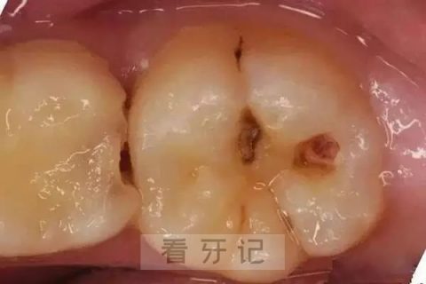 蛀牙龋齿三大阶段附高清图片