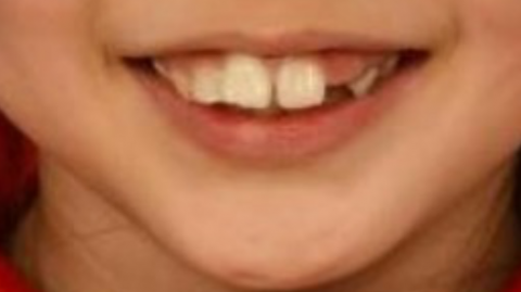 前牙突出牙齿不齐的小美看牙记