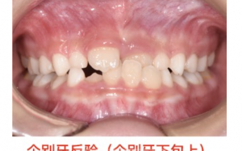 早期矫治六大儿童人群整理附牙齿畸形真实对比照片