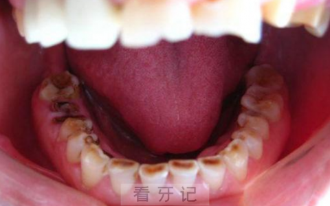夜磨牙危害严重图片照片