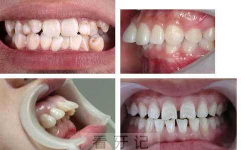 青少年哪些牙齿需要矫正附六大必须正畸的类型