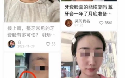正畸后遗症牙套脸长什么样附对比图及解读