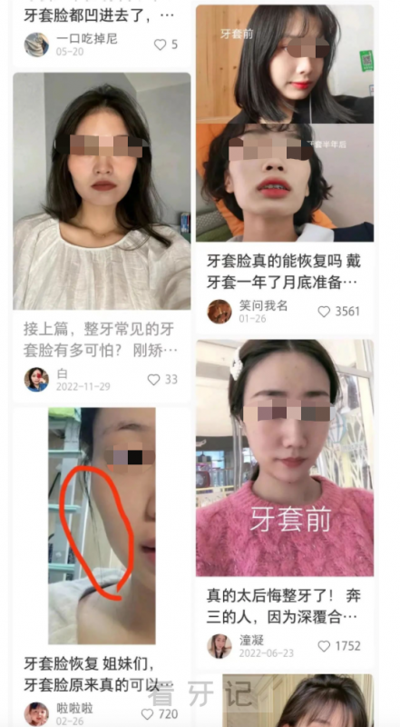 正畸后遗症牙套脸长什么样附对比图及解读