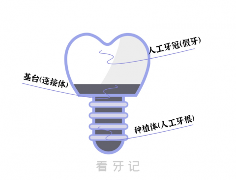 你真的了解种植牙吗？到底什么是种植牙