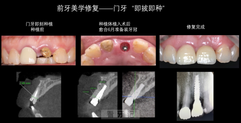 上海市口腔医院即刻种植看牙记