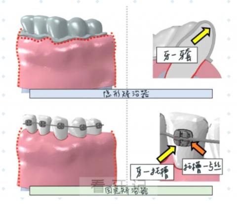**告诉你隐形矫正和固定矫治有什么区别