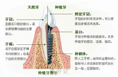 医生不一定会告诉你种植牙和真牙有啥本质区别